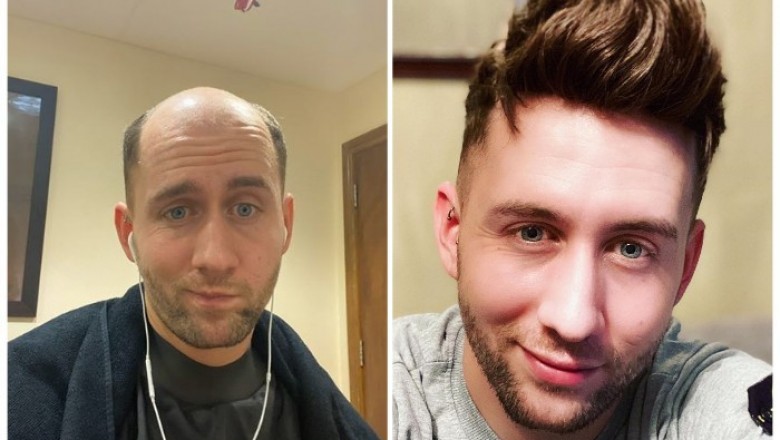 How I stick my hair system and style it at home