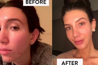 5 top Supplements for hormonal acne