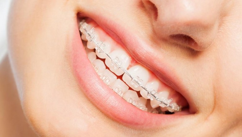 Clear Braces or Invisalign: Which Are Right For You?
