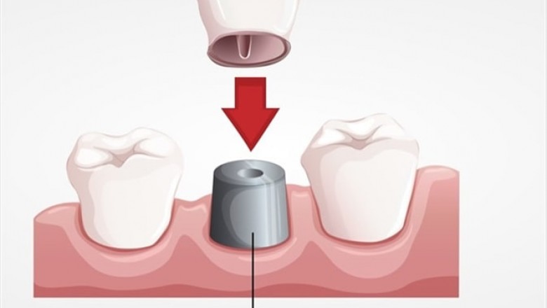 Repair Tooth Decay and Cracked Tooth With Dental Crowns