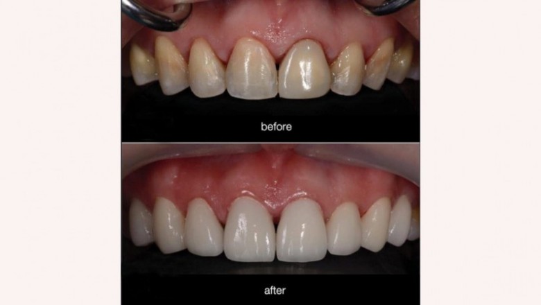 What Can You Expect If Getting Dental Veneers?