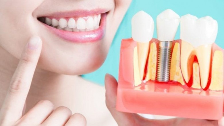 Bio implants Market Research – Industry Analysis