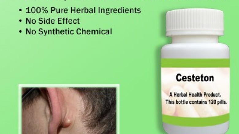 5 Natural Remedies for Sebaceous Cyst Help to Reduce the Size of Cyst