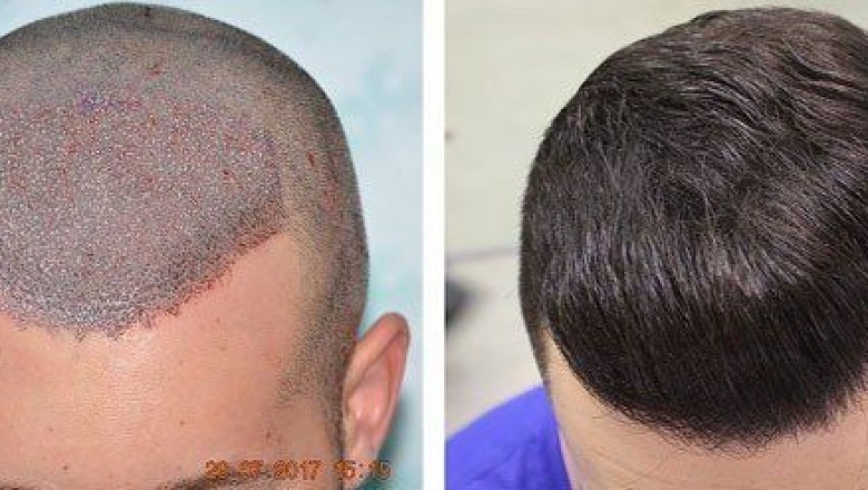 Hair Transplant Dubai – Some Facts You Need to Know