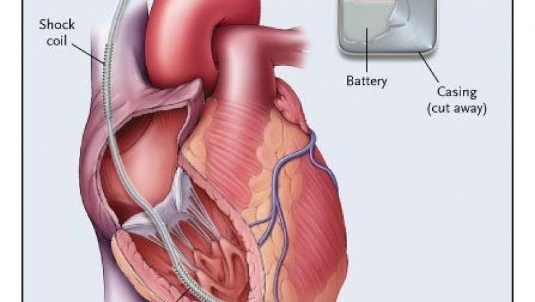 Implantable Defibrillators Market Global Overview and Strategic Regional Analysis 2020 to 2030