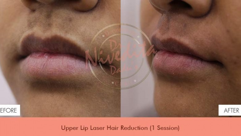 Best Laser Hair Removal in Delhi