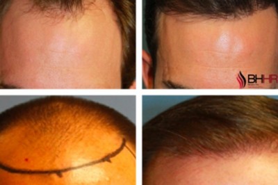 Fue Hair Transplants