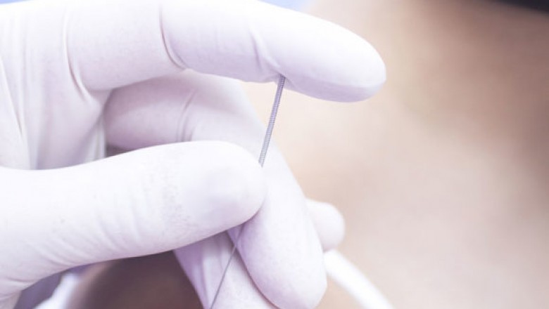 Bio Medical Dry Needling, Calgary - Credence Physiotherapy & Massage