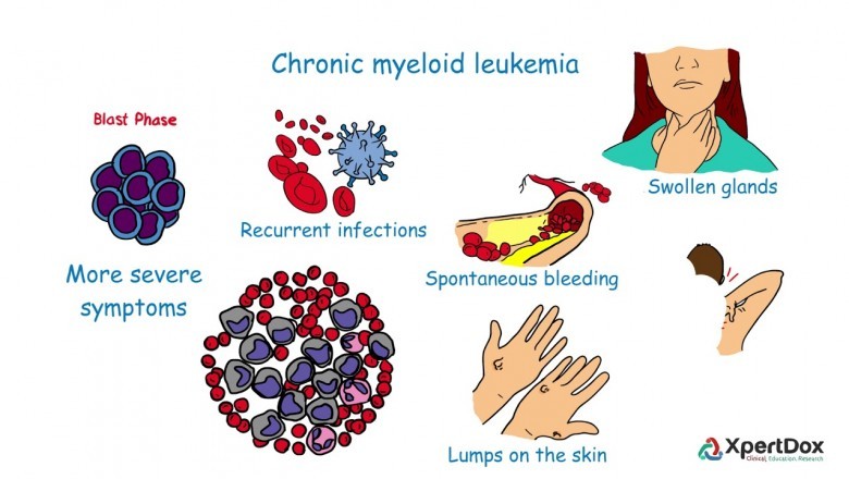 Novel treatment options for Chronic Myeloid Leukemia allow patients to recover faster than ever before