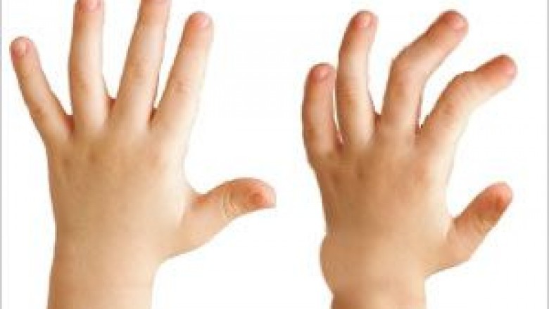 Treatment of Hunter Syndrome; Depends on age and severity of condition