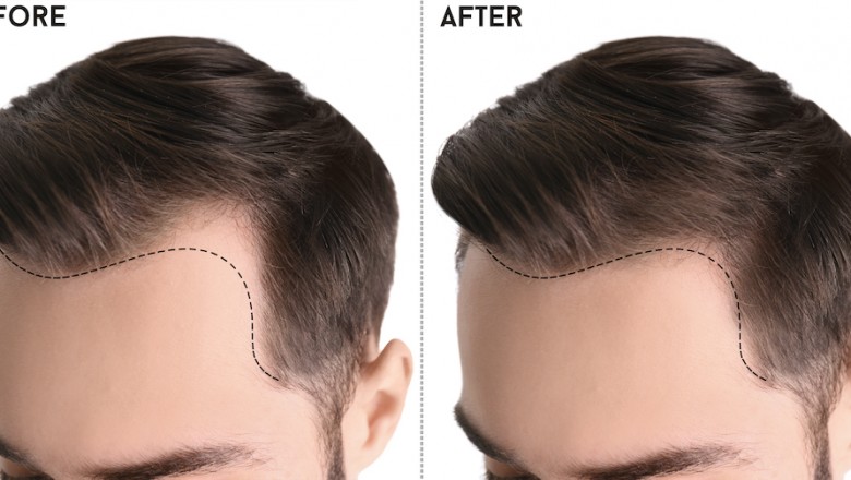 An Ultimate Guide for Hairline Lowering Surgery