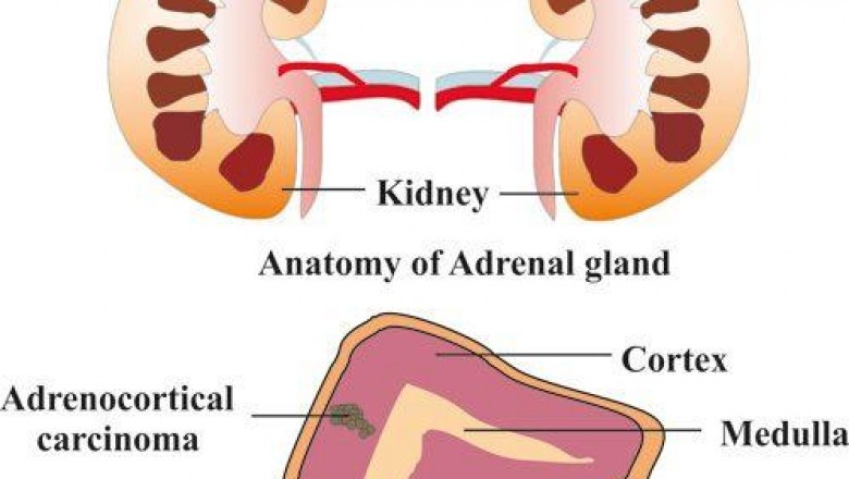 Novel adrenocortical carcinoma treatment options are significantly safer and more effective, enabling patients with faster recovery
