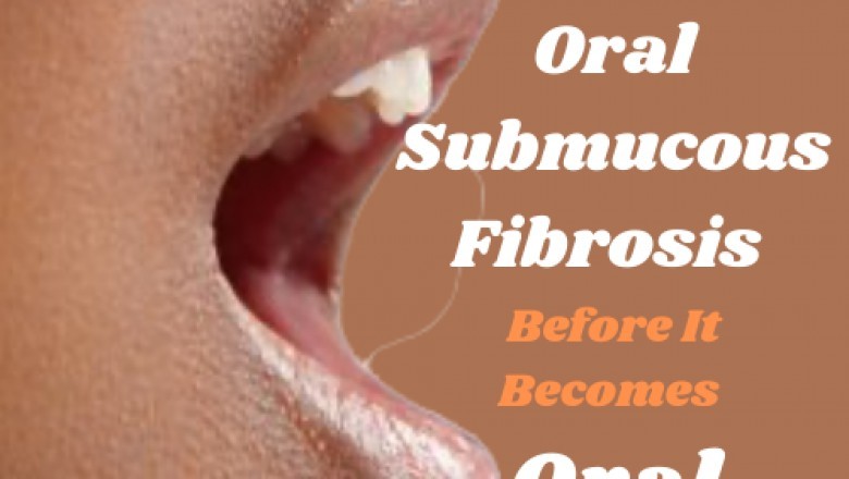 Beat Oral Submucous Fibrosis Before It Becomes Oral Cancer — Only With Osmf Mouth Opening Kit