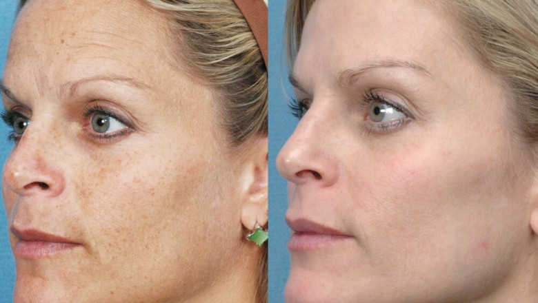 What does intense pulsed light (IPL) therapy do for your face?