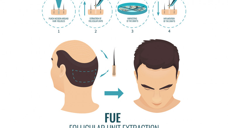 Rebuilding Your Confidence With A Hair Transplant
