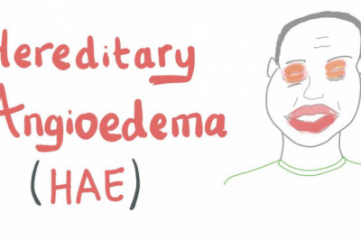 Hereditary Angioedema Market Beyond US$ 3.4 Billion By 2025 - Coherent Market Insights