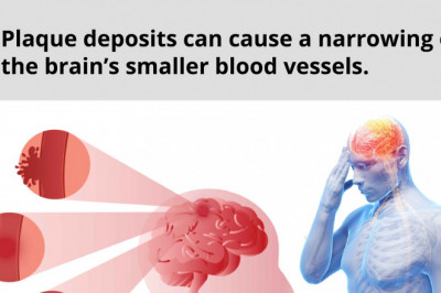 Get the Best Tia Treatment in NYC | Pain Management and Neurology Services