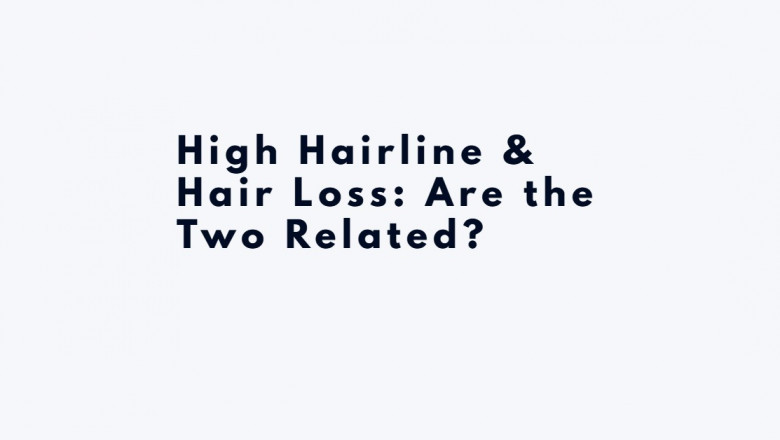High Hairline & Hair Loss: Are the Two Related?
