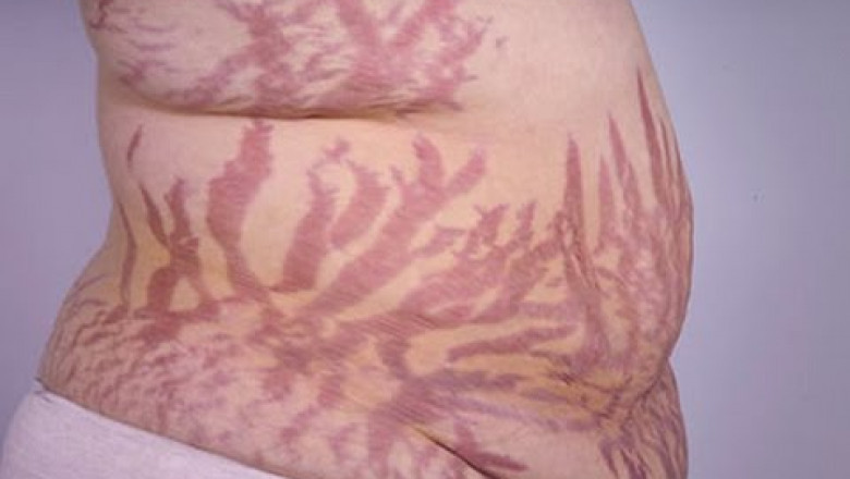 Antipsychotic Drugs are Commonly Prescribed to Treat Symptoms of Cushing's Syndrome.