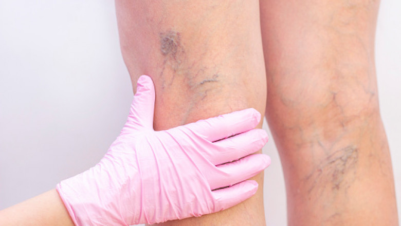 How to get rid of spider veins