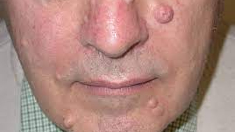 Neurofibromatosis is caused due to a genetic mutation, resulting in the formation of tumors in various parts of a body