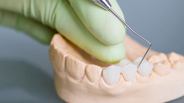 Dental Bridges Treatment at Your Tanglewood Houston Dentist