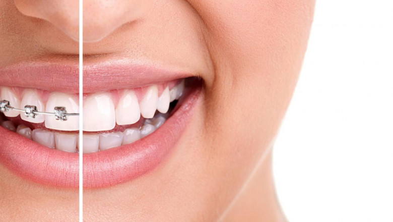 Ceramic Braces - Conveniently Acquiring A Great Smile