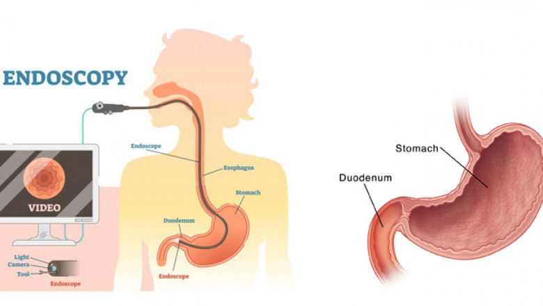 Duodenal Cancer Treatment in Gurugram, Gurgaon, Haryana, Delhi, NCR, India | Dr. Priya Tiwari