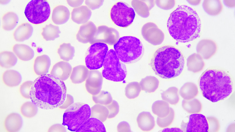 Patients will now heal faster than ever before thanks to new Chronic Myeloid Leukemia Treatment Options
