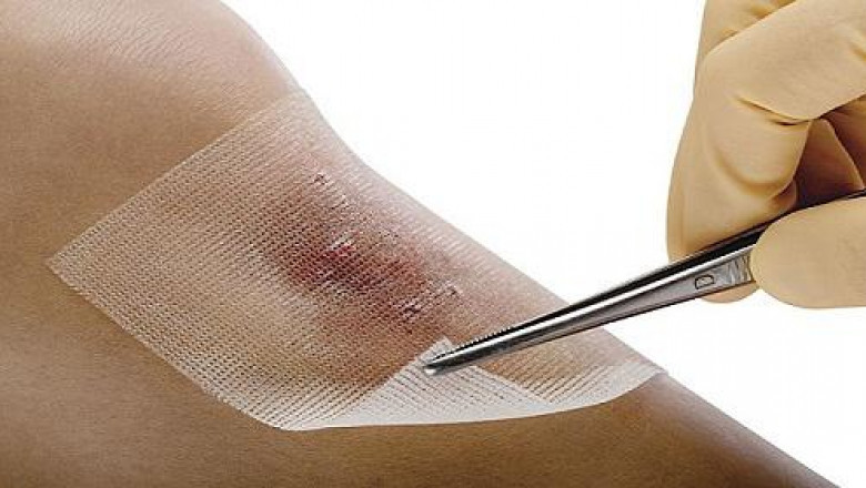 Antimicrobial wound dressing has been one of the most common treatments for a variety of skin conditions