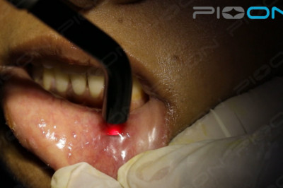 Applications of Low-Level laser therapy in dental practice