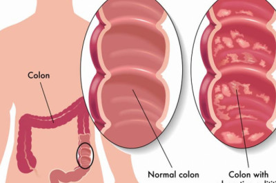 Ulcerative Colitis Market Size, Trends, Shares, Insights and Forecast – 2018-2026