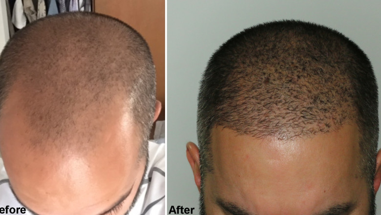 Kinds of Treatments offered by Hair Transplant Clinics in Los Angeles
