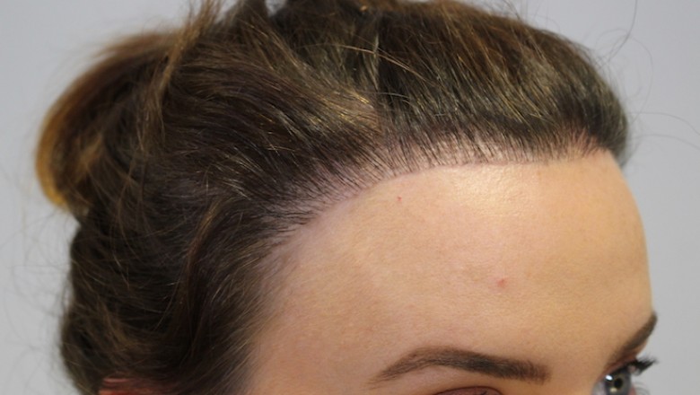 Can a Poorly Done Hair Transplant be Fixed?