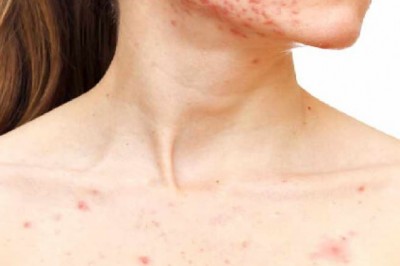 Choose the best acne skin treatment solution
