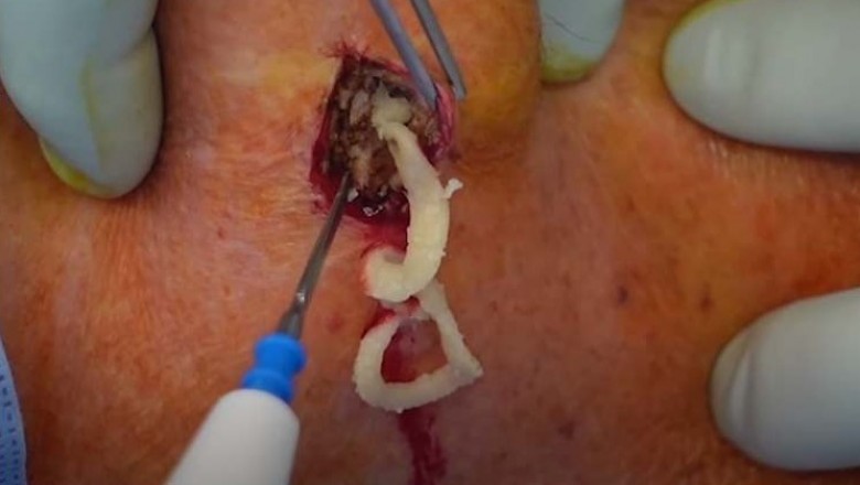 Cutting and Draining a Massive Sebaceous Cyst | New Pimple Popping Videos