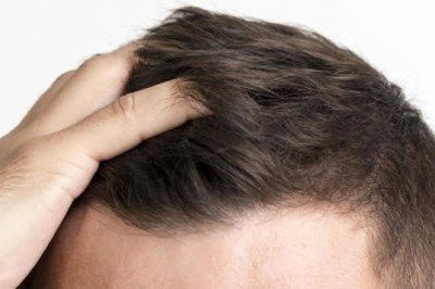 What to Expect After a Hair Transplant