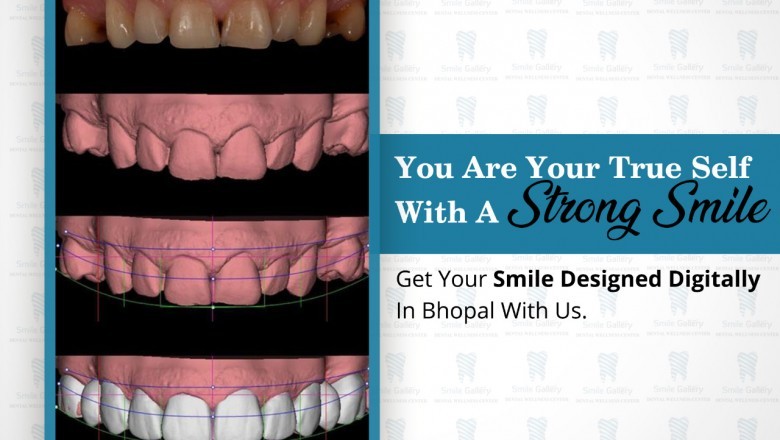 Root canal Treatment cost in bhopal