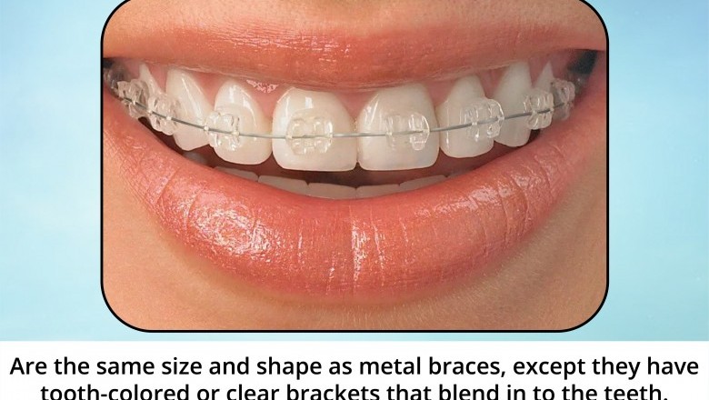 Ceramic Braces | Urgent Dental Care