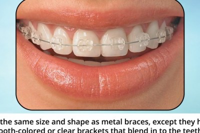 Ceramic Braces | Urgent Dental Care