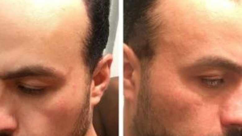 Thingsyou could do with your male lace front on