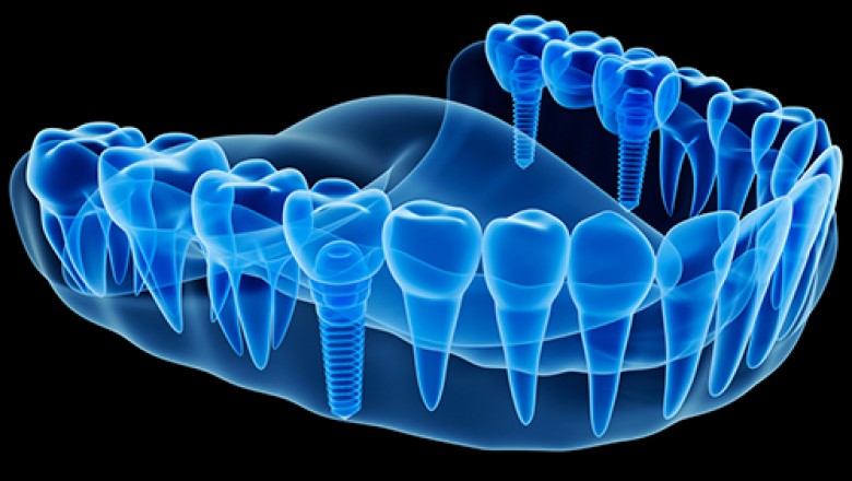 Dental Implants Surgery