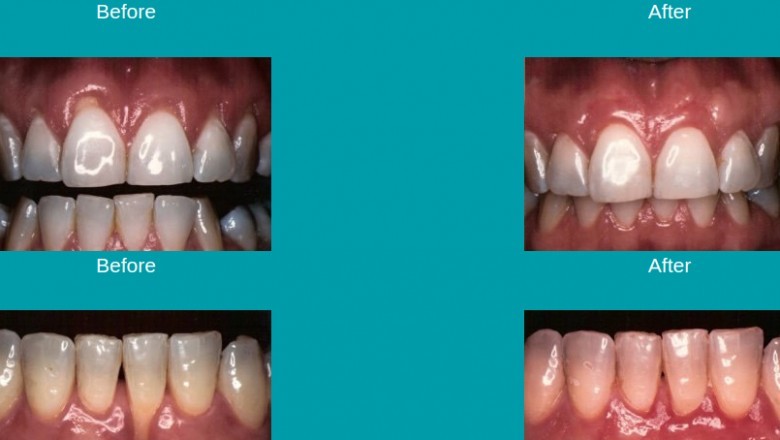 Dental Implants in Pembroke Pines and Cooper City | Dr. Richard Salzmann