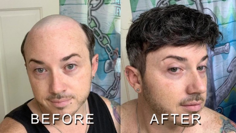 How does a men'sfrontal hairpiece work and who is it for?