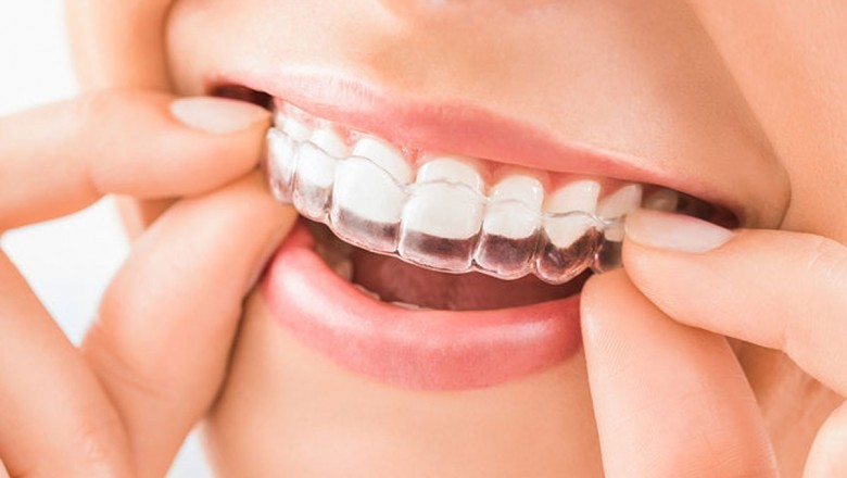 Clear Aligners; an Alternative to Traditional Braces without Metal Wire or Brackets