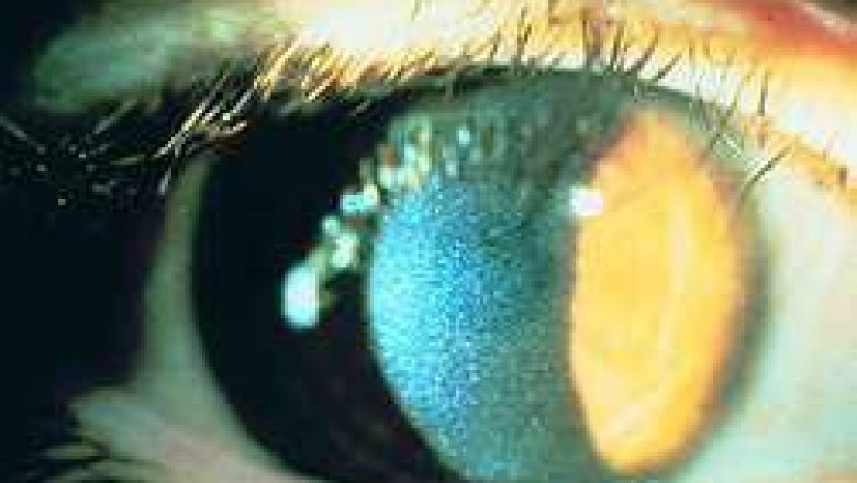 Patients with Cystinosis, a condition marked by a high accumulation of cysteine in the body, are given treatment