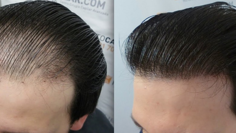 What to Choose Between Hair Weaving and Hair Transplantation?