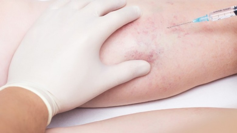Advantage Of Microsclerotherapy Treatment Is That It Is Effective In Treatment Of A Wide Variety Of Pain