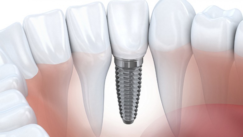 Osseointegration Implants Is A Type Of Implant That Contains Pores In Which Osteoblasts And Cells Containing Connective Tissue Can Migrate Freely