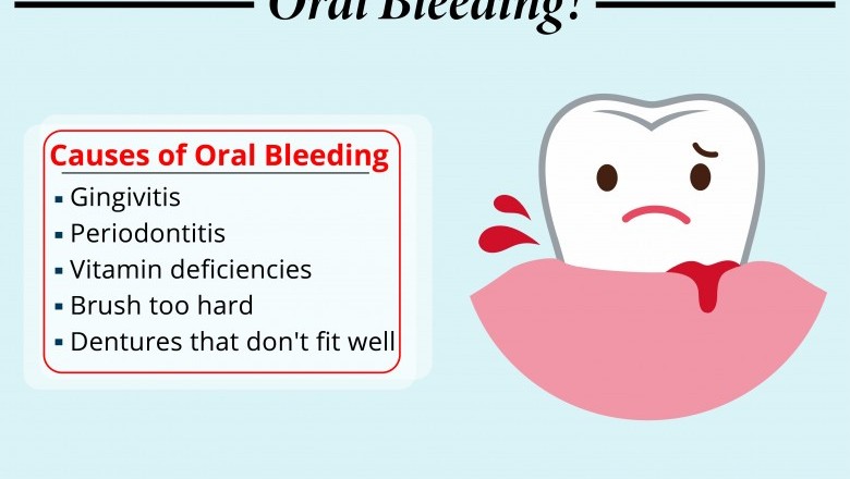 Causes of Oral Bleeding | Best Emergency Dentists